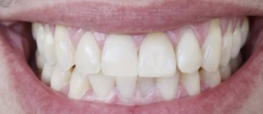 The same smile after a natural-looking crown
