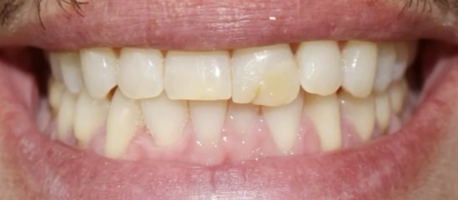 Smile before treatment, with a discolored, chipped front tooth