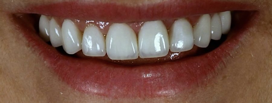 The same smile after a gum lift and veneers