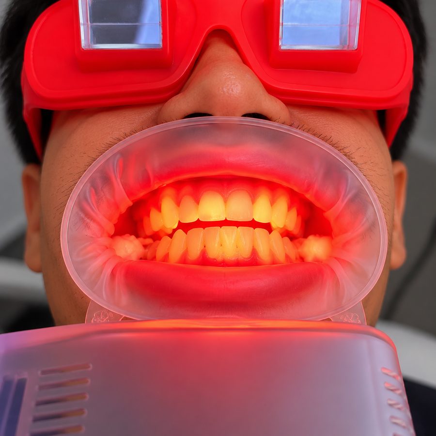 Patient's teeth under red light during SuperGlo whitening