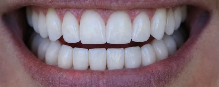 The same smile after veneers and bonding, with even, full teeth