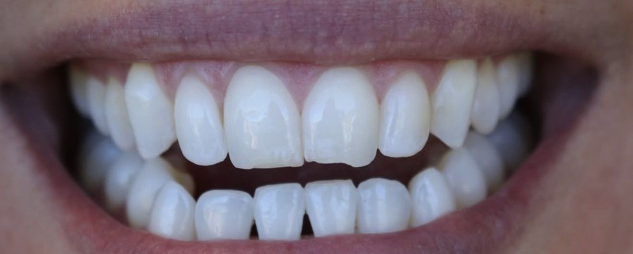 Smile before veneers, with gaps and uneven edges